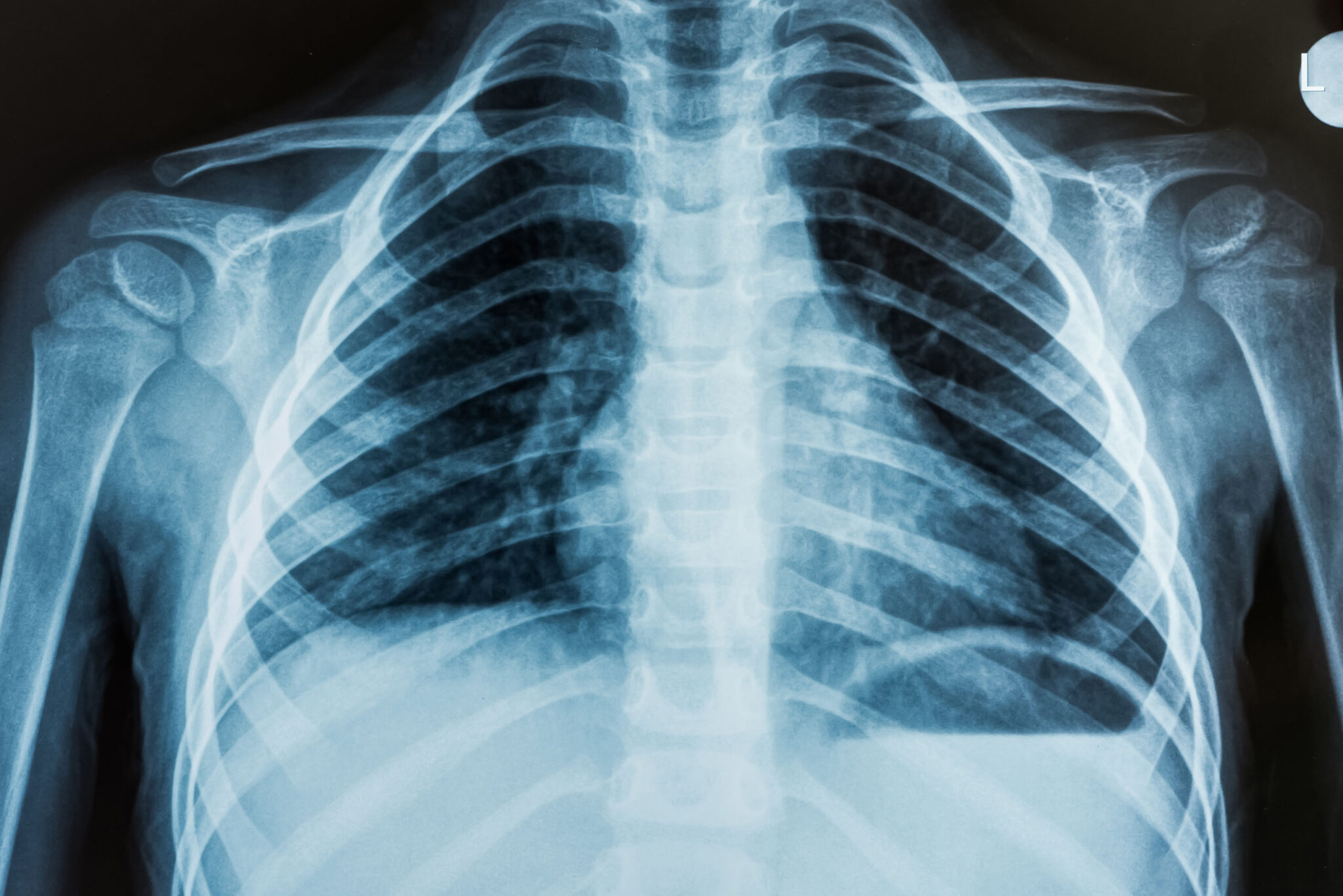 Chest X-ray